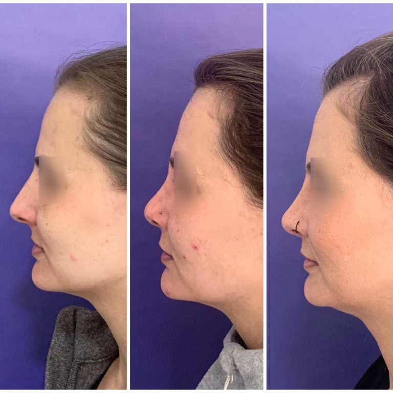 resultado-rinoplastia (1)