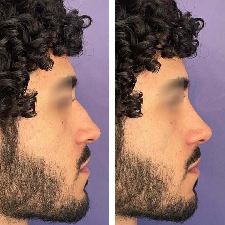 resultado-rinoplastia (2)