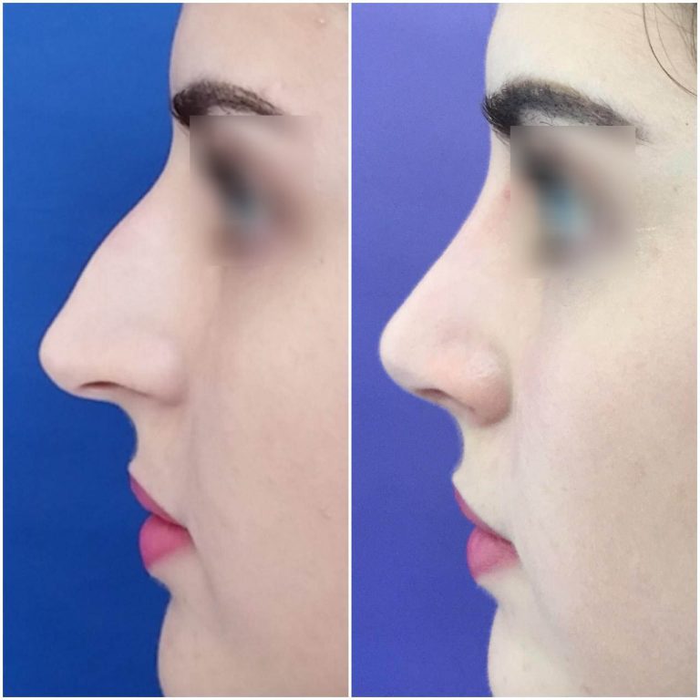 resultado-rinoplastia (3)