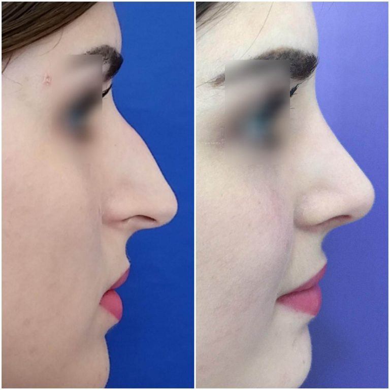 resultado-rinoplastia (4)