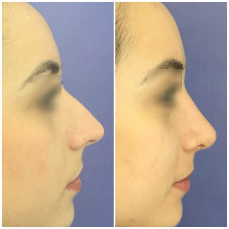 resultado-rinoplastia (5)