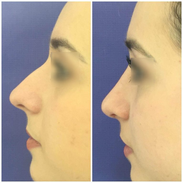 resultado-rinoplastia (6)