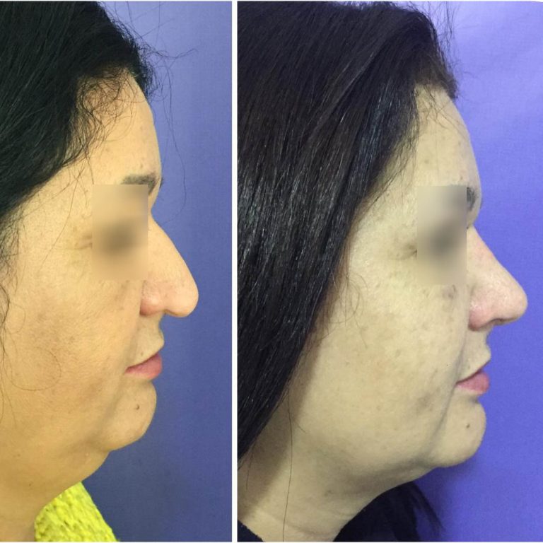 resultado-rinoplastia (7)