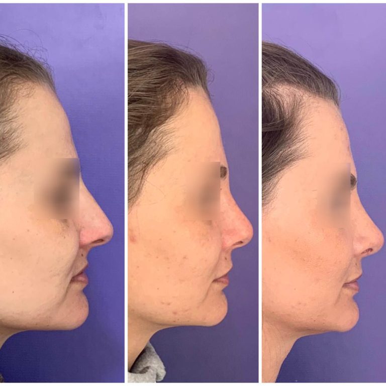 resultado-rinoplastia (8)